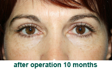 plastic-surgery-blepharoplasty